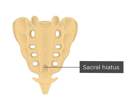 Fused Sacral Hiatus