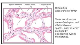 Respiratory Distress Syndrome (HYALINE MEMBRANE DISEASE) | PPT