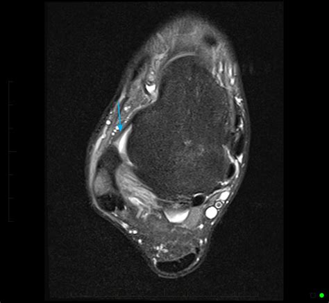 MRI of Foot and Ankle - normal anterior talofibular ligament - MRI at Melbourne Radiology Clinic