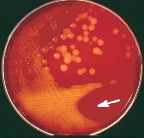 Streptococcus pyogenes, enemiga silenciosa