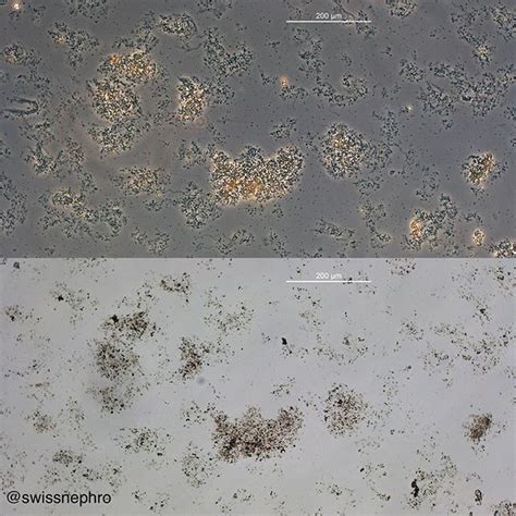 Amorphous phosphates a common finding in alkaline urine. (Phase contrast bright field original ...