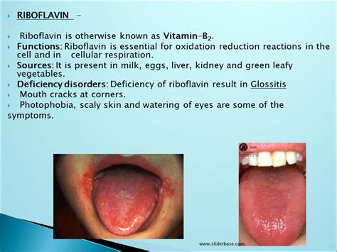 Vitamins - Presentation Health and Disease