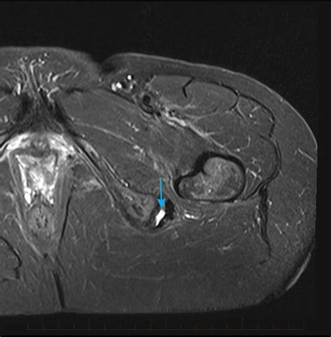 MRI of Sports Injuries - Musculoskeletal MRI