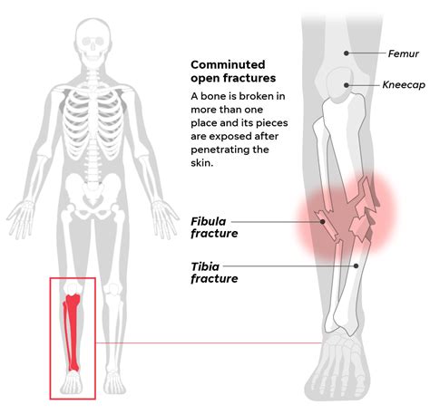 Tiger Woods Leg Photos : Tiger Woods Suffers Multiple Leg Injuries Undergoes Surgery After ...