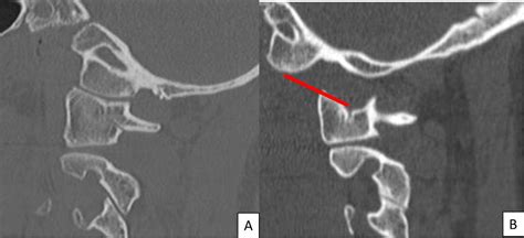 Atlanto Occipital Joint Xray