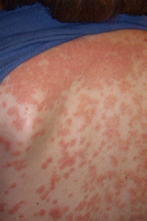 Guttate psoriasis: Causes, symptoms, and treatment