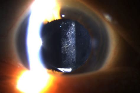 YAG Capsulotomy (YAG Laser Eye Surgery) - Vitreous Retina Macula ...