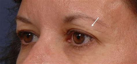 Eyelid Thermage Before and After Pictures | Santa Monica Laser and Skin Care Center