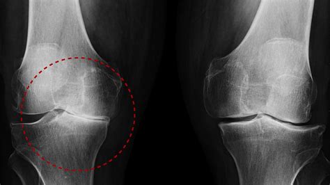 Que Es La Artrosis De Rodilla - Image to u