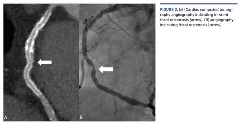 Coronary Stent Fracture: Still a Cause of Stent Failure