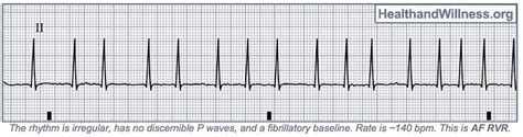 A Nurse Is Reviewing the Ecg Rhythm Strip - Elston Leye1985