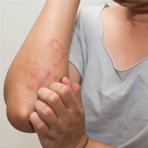 Itchy skin? Eczema likely has a genetic component - Genetic Literacy Project