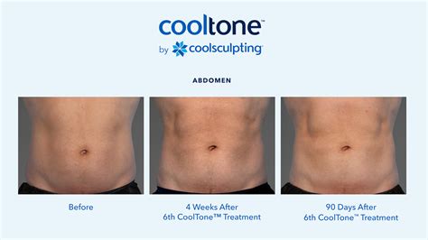 CoolSculpting Procedures Scottsdale AZ | Fat Removal Phoenix