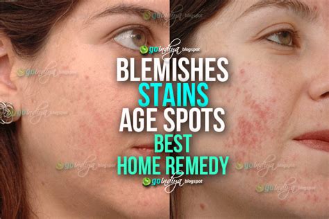 Best ever home remedy to remove blemishes, dark spots and age spots - Natural Home Remedies ...