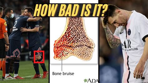 Expert Explains Lionel Messi Injury (knee "bone bruise") & Timeline ...