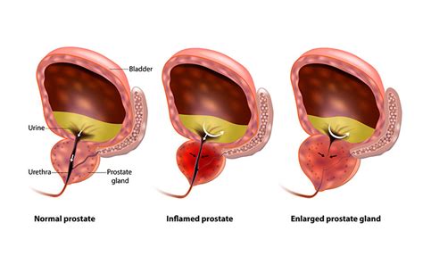 Prostate Health