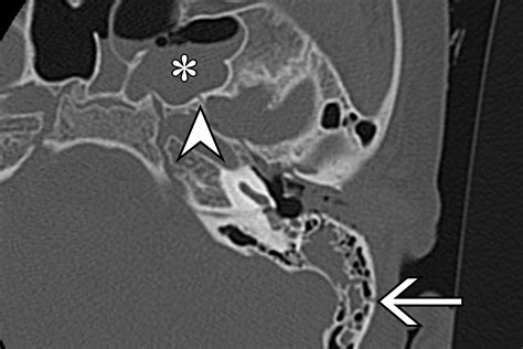 Temporal Bone Trauma: Typical CT and MRI Appearances and Important Points for Evaluation ...