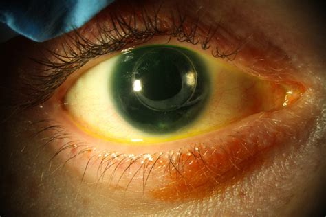 Aniridia: for patients - Gene Vision