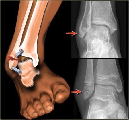 How Ankle Fractures are Managed and Treated