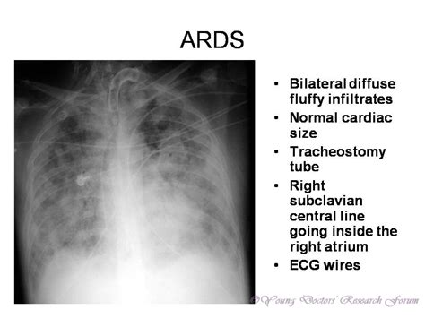 Identification of Chest X-rays of Common Lung Diseases ~ YOUNG DOCTORS ...