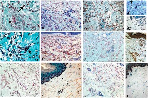 Orcein staining and immunolabellings. a–d: PXE skin. Orcein staining... | Download Scientific ...