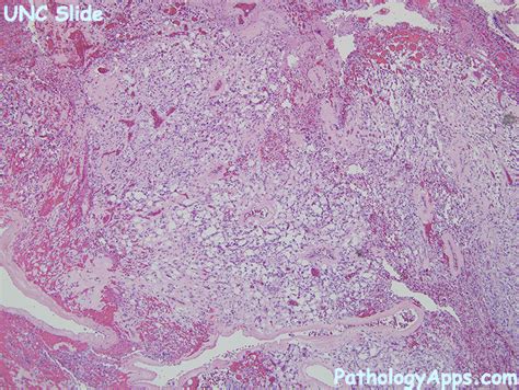 hemangioblastoma pathology