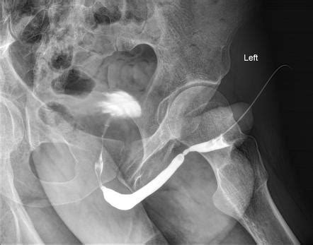 Urethral Stricture Diagram