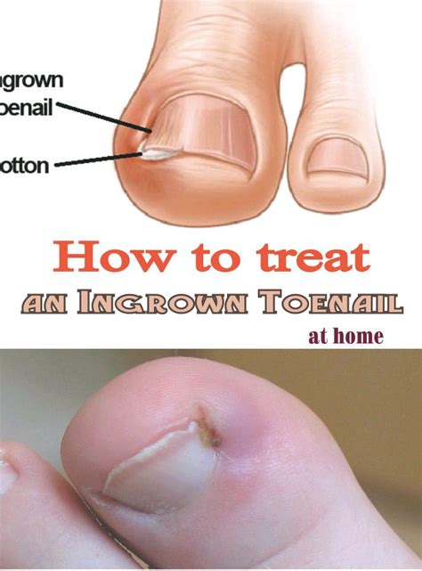 How To Care Ingrown Toenail - How To Care Info