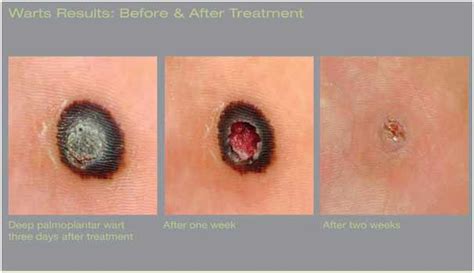 liquid nitrogen warts removal - pictures, photos