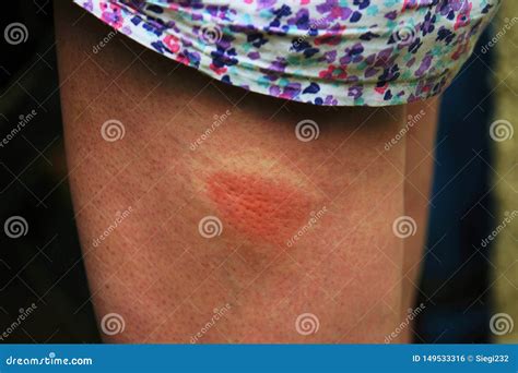 Painful insect bite stock photo. Image of allergic, sting - 149533316