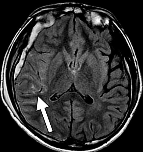 Traumatic Brain Injury: Imaging Patterns and Complications | RadioGraphics