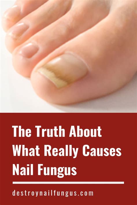 What Causes Nail Fungus? The Top 5 Causes Revealed in 2020 | Nail ...