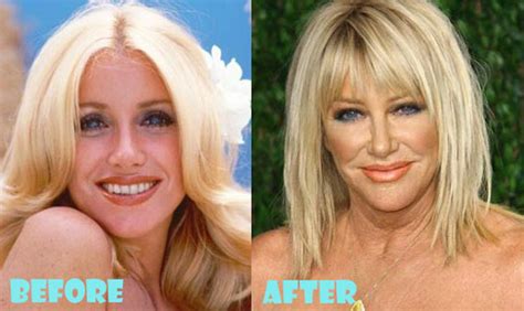 Suzanne Somers Plastic Surgery Before and After - Lovely Surgery