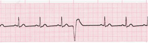 Premature Ventricular Complexes (PVC's) ECG Interpretation #315