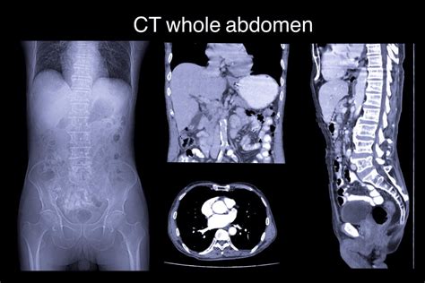 CT whole abdomen - ODC