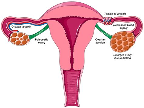 Swollen Ovaries