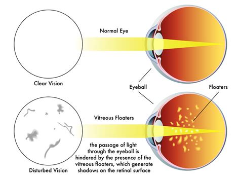 A New Treatment to Diminish Eye Floaters | Health - BabaMail