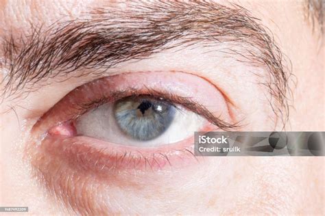 Indented And Irregular Pupil After Lens Surgery Stock Photo - Download Image Now - Iris - Eye ...