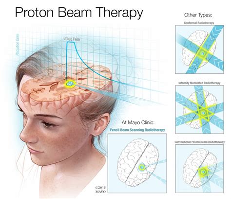 About proton beam therapy