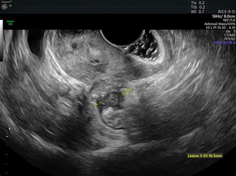 Diagnosing Endometriosis by Comparing Ultrasound & MRI | Empowered Women's Health