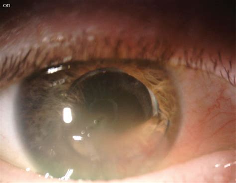 Corneal edema after cataract surgery | doctorvisit