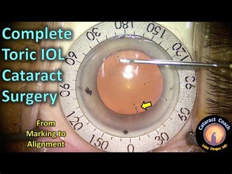 Torque lenses for cataract surgery | doctorvisit