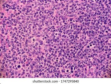 2 Marginal Zone Lymphoma Cells Images, Stock Photos, 3D objects ...