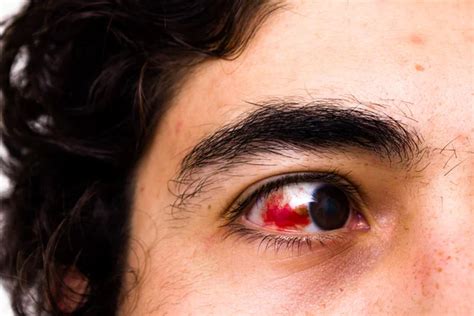 ᐈ Eye injury stock images, Royalty Free eye injury pics | download on ...