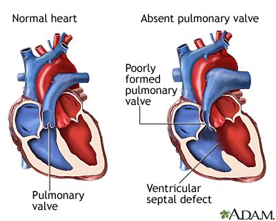 Pulmonary Valve Location