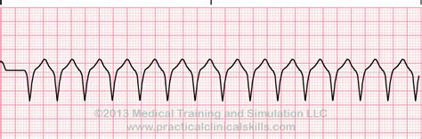 Matters of the Heart - V-Tach — PatMac,RN