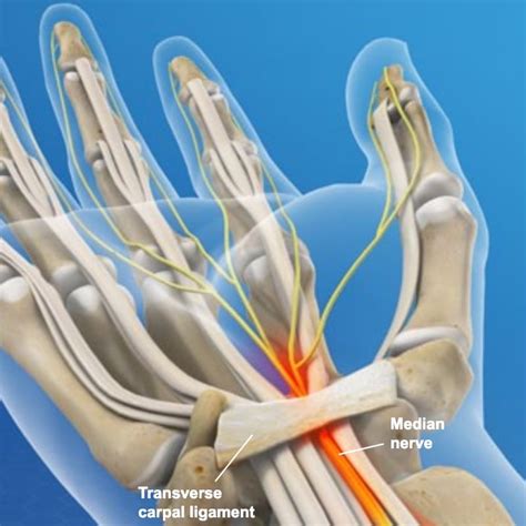 Carpal Tunnel Release | Sierra Neurosurgery Group