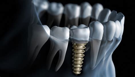 Dental Implant Procedure - One Stage