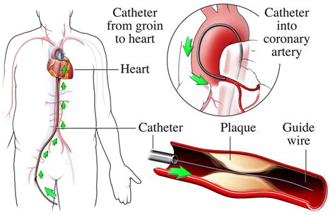 Cardiac Catheterization - During Cardiac Catheterization | NHLBI, NIH