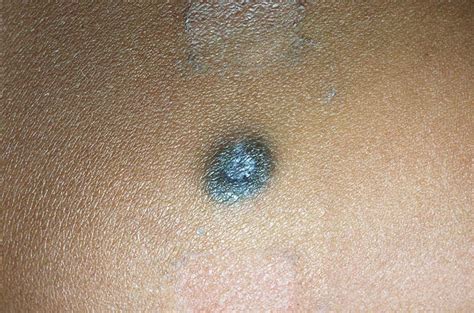 Melanocytic Nevi – Blue Nevus Overview | Perri Dermatology